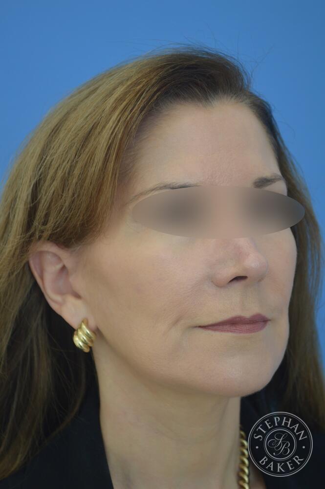 Face & Neck Lift Before & After Image