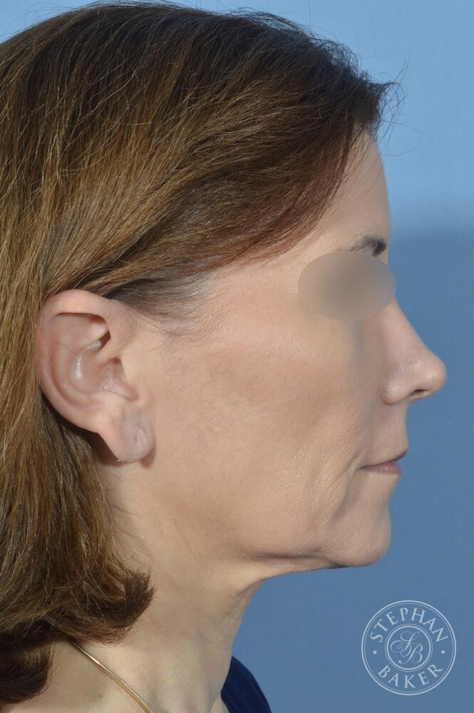 Face & Neck Lift Before & After Image