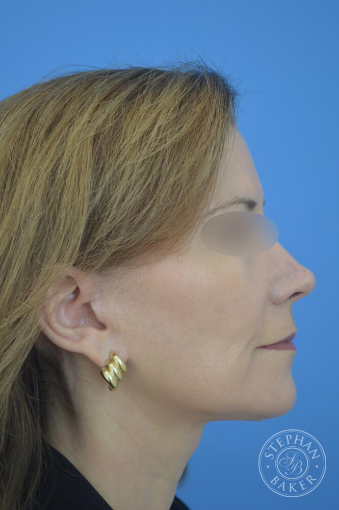 Face & Neck Lift Before & After Image