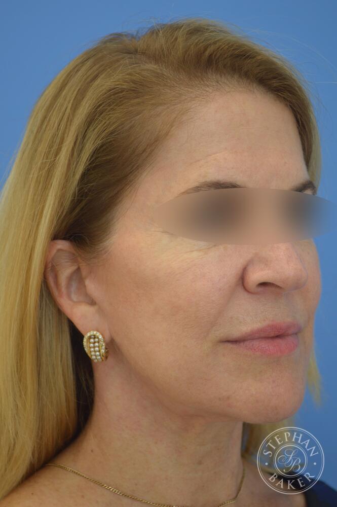 Face & Neck Lift Before & After Image