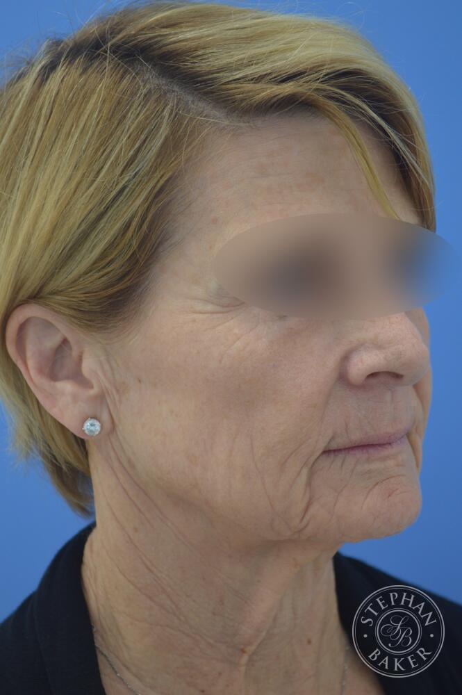 Face & Neck Lift Before & After Image