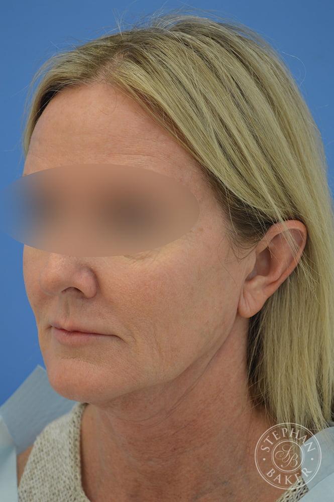 Face & Neck Lift Before & After Image