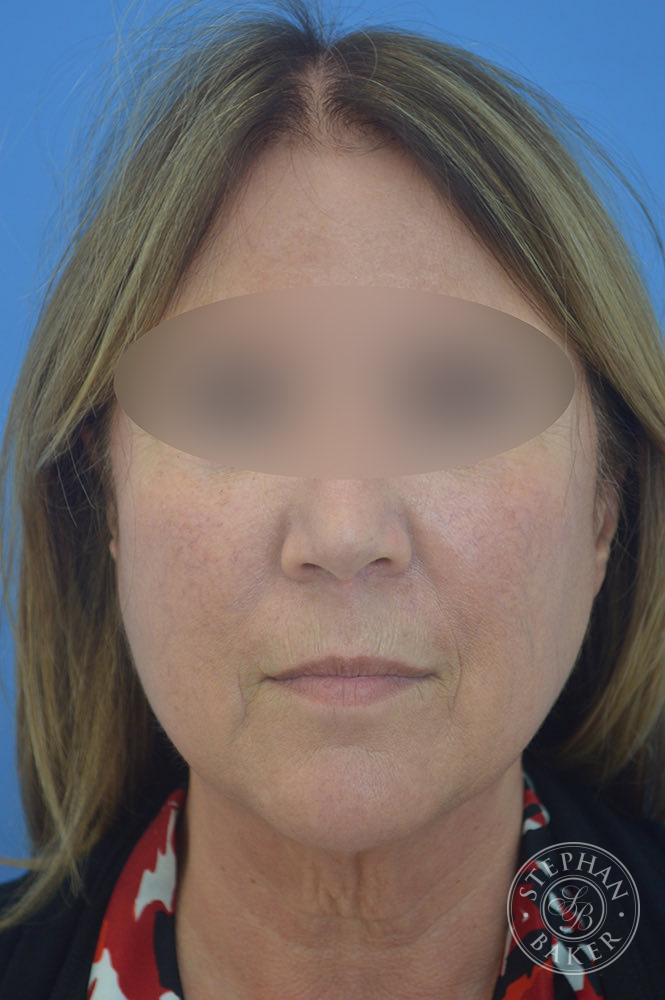 Face & Neck Lift Before & After Image