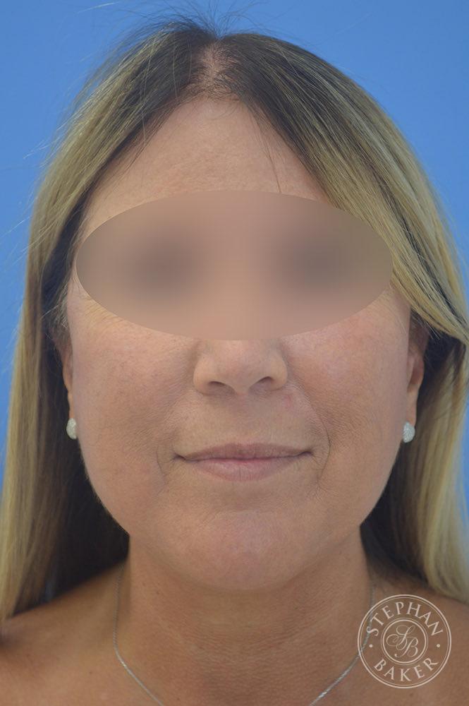 Face & Neck Lift Before & After Image