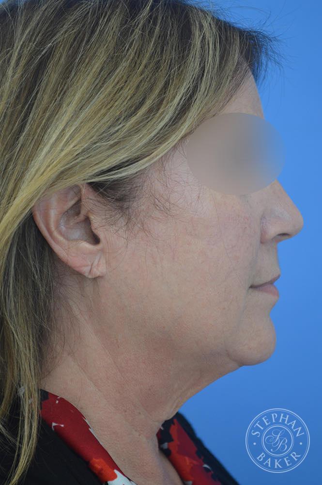 Face & Neck Lift Before & After Image