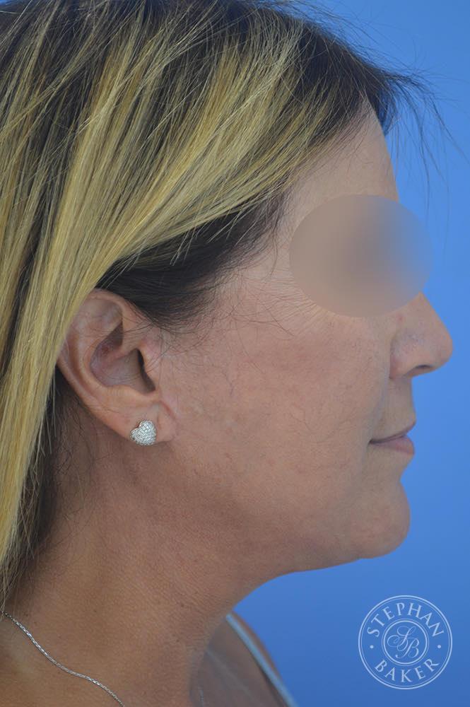 Face & Neck Lift Before & After Image