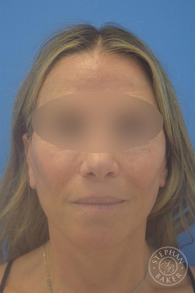 Face & Neck Lift Before & After Image