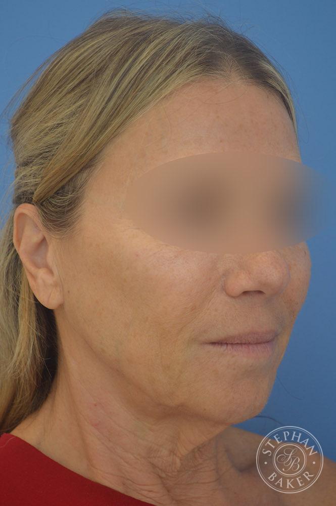 Face & Neck Lift Before & After Image