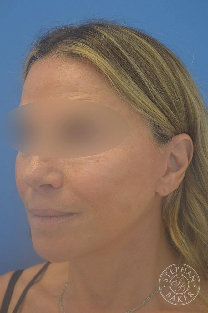 Face & Neck Lift Before & After Image