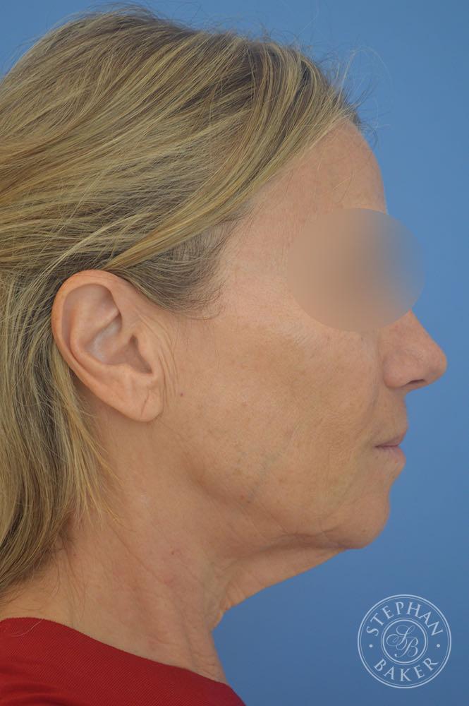 Face & Neck Lift Before & After Image