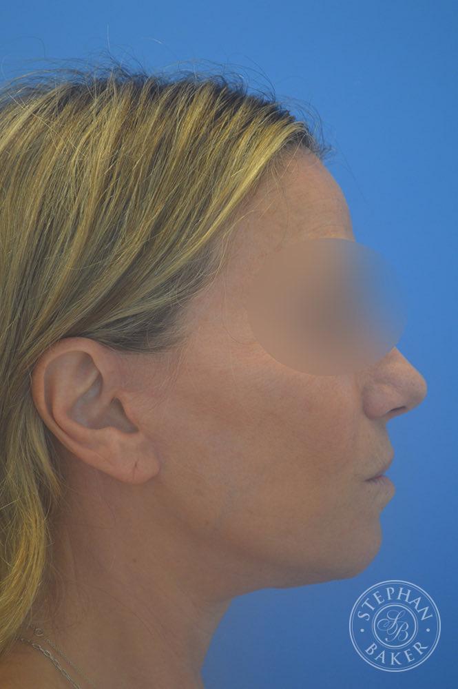 Face & Neck Lift Before & After Image