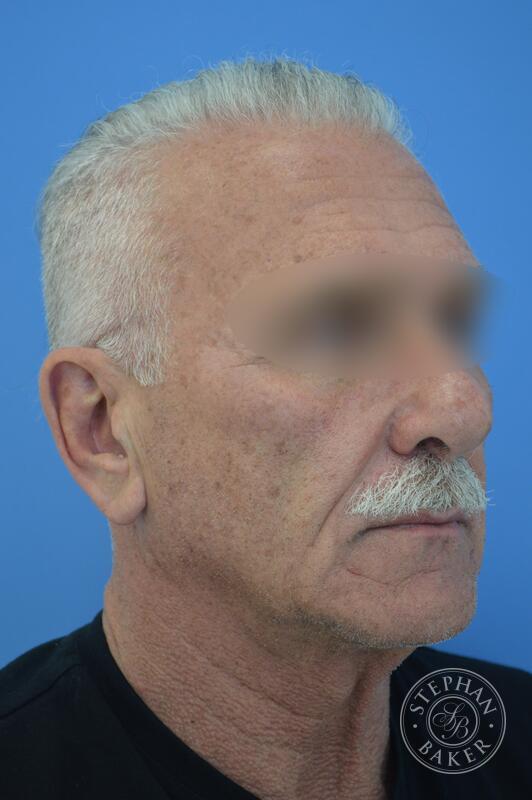 Male Facelift Before & After Image