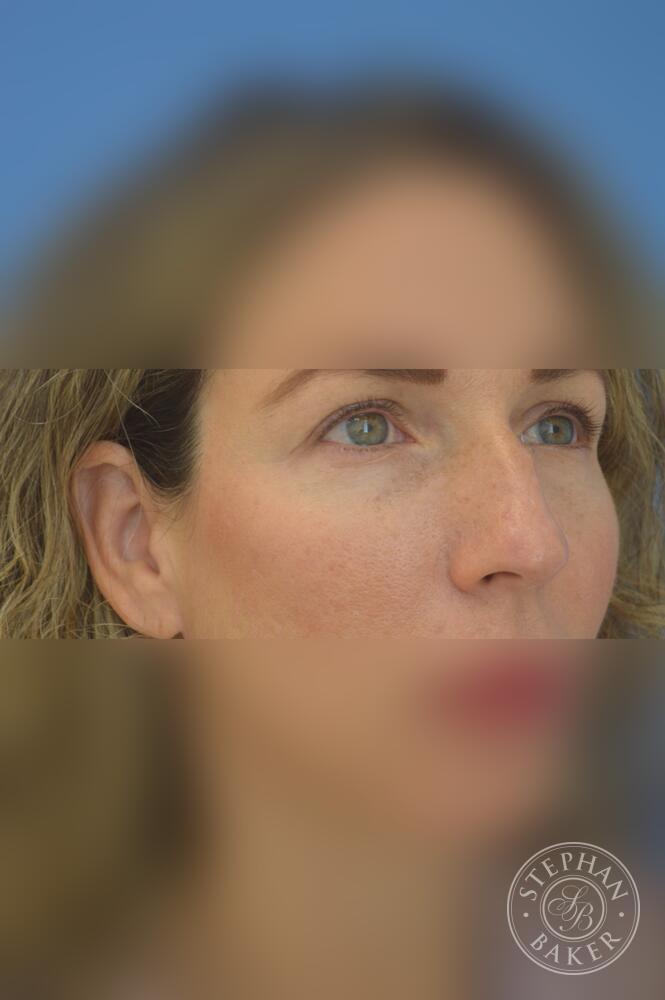 Rhinoplasty Before & After Image