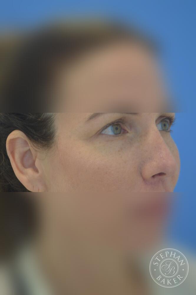 Rhinoplasty Before & After Image
