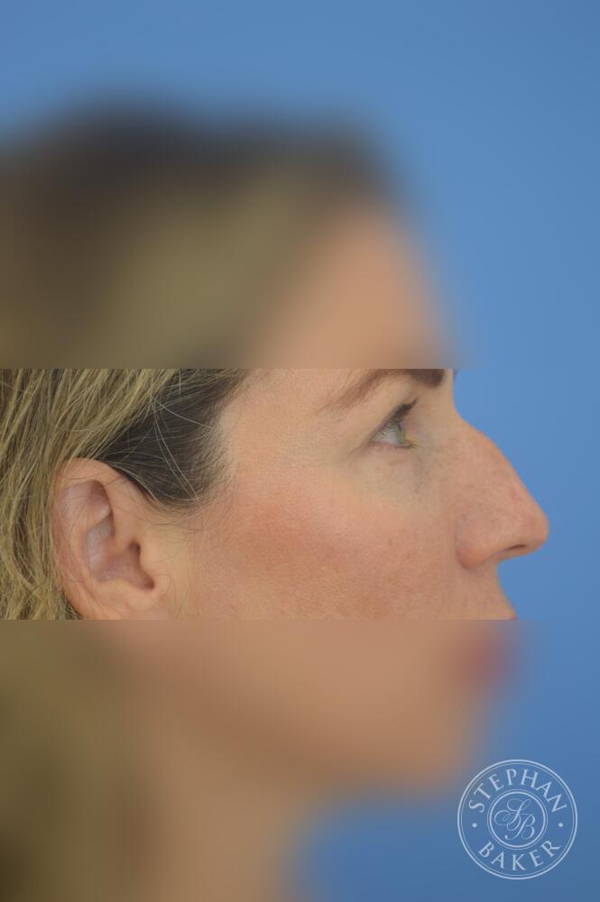 Rhinoplasty Before & After Image
