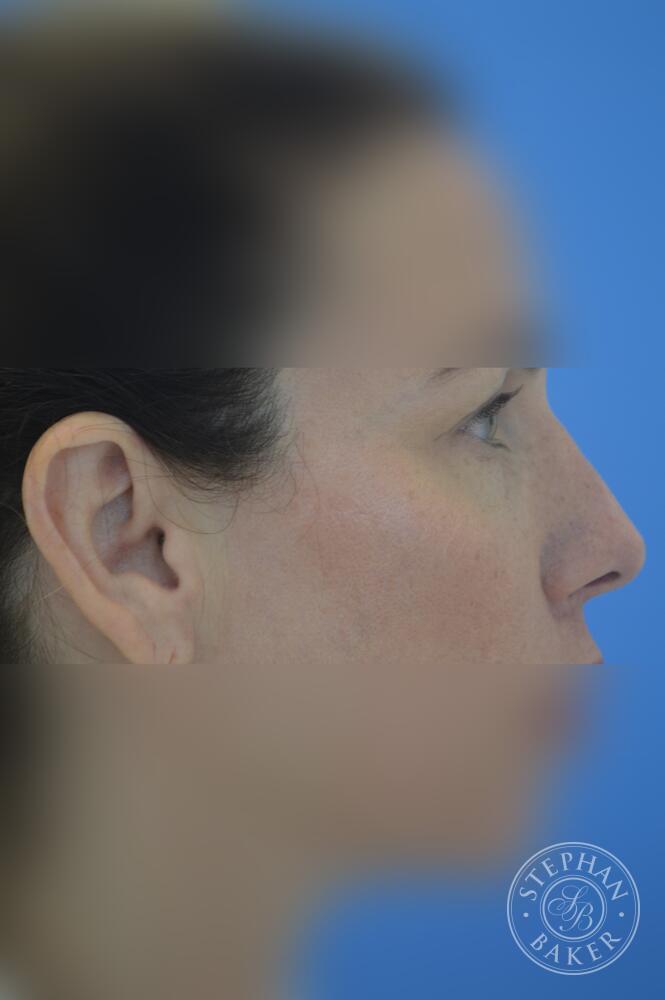 Rhinoplasty Before & After Image