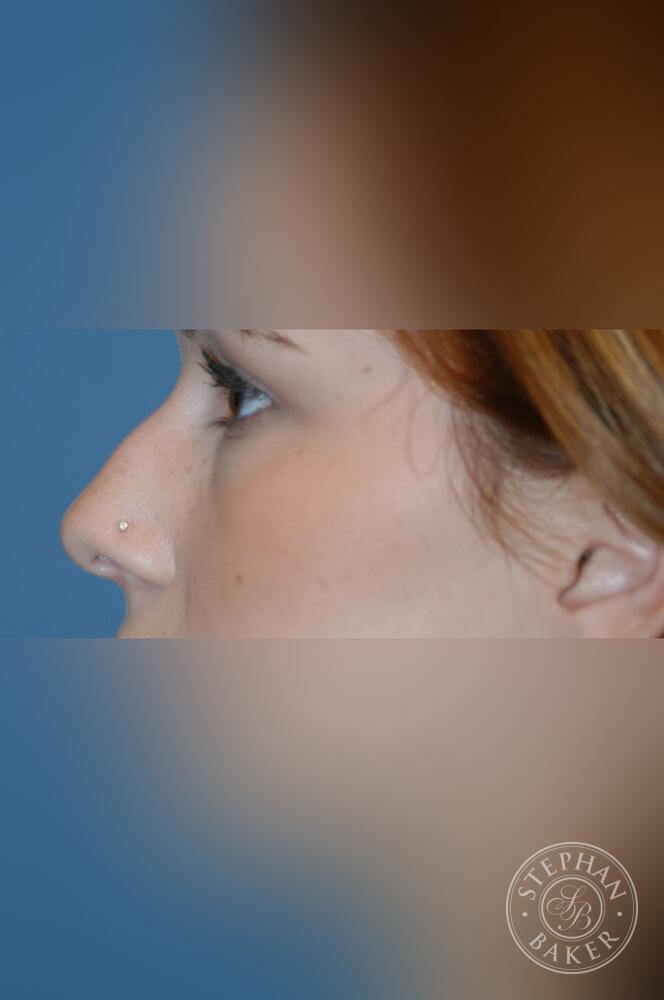 Rhinoplasty Before & After Image