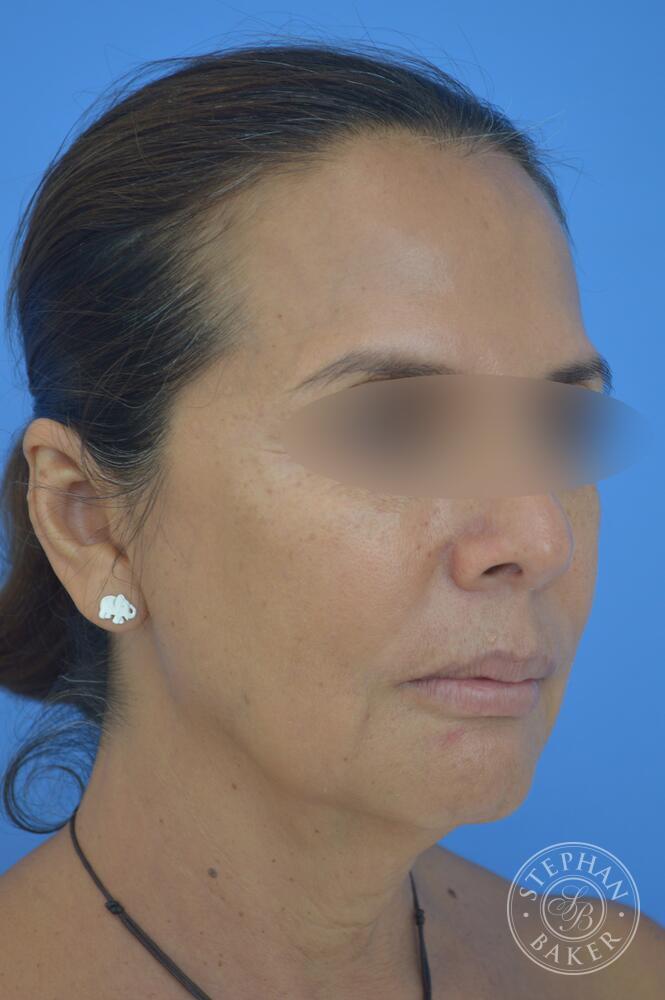 Face & Neck Lift Before & After Image