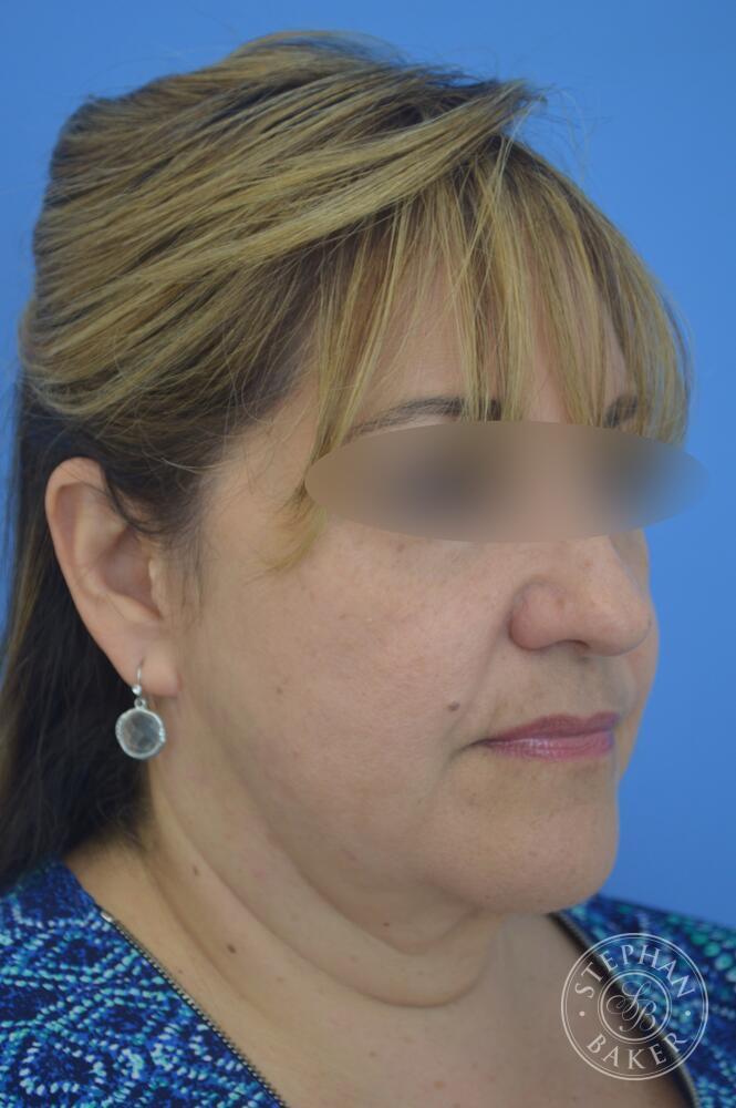 Face & Neck Lift Before & After Image