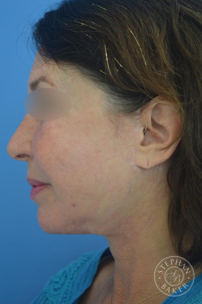 Face & Neck Lift Before & After Image