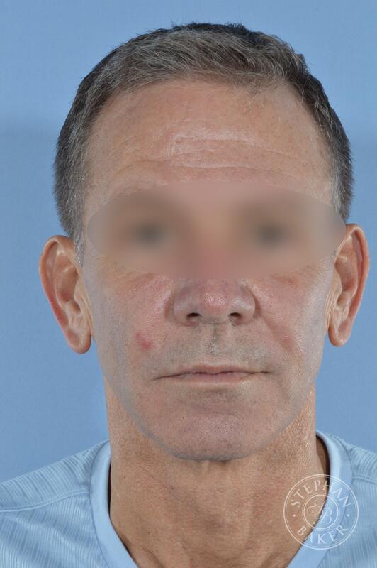 Male Facelift Before & After Image