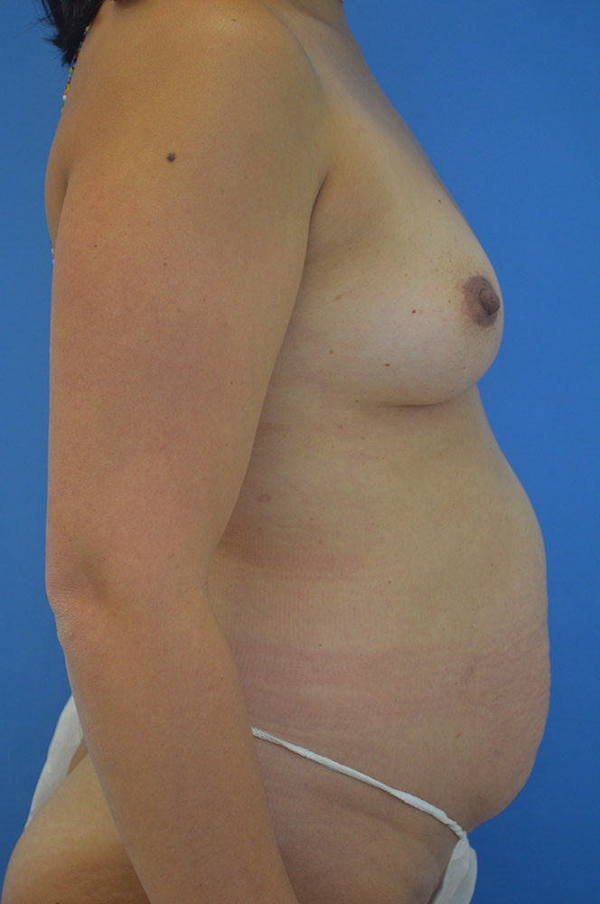 Mommy makeover Before & After Image