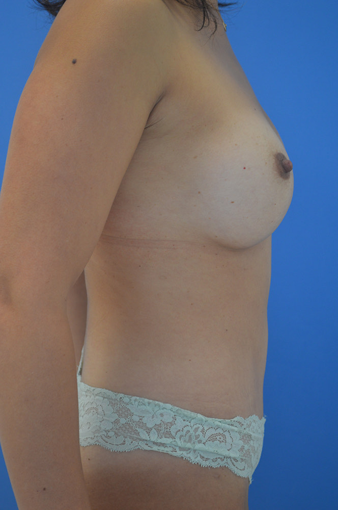 Mommy makeover Before & After Image