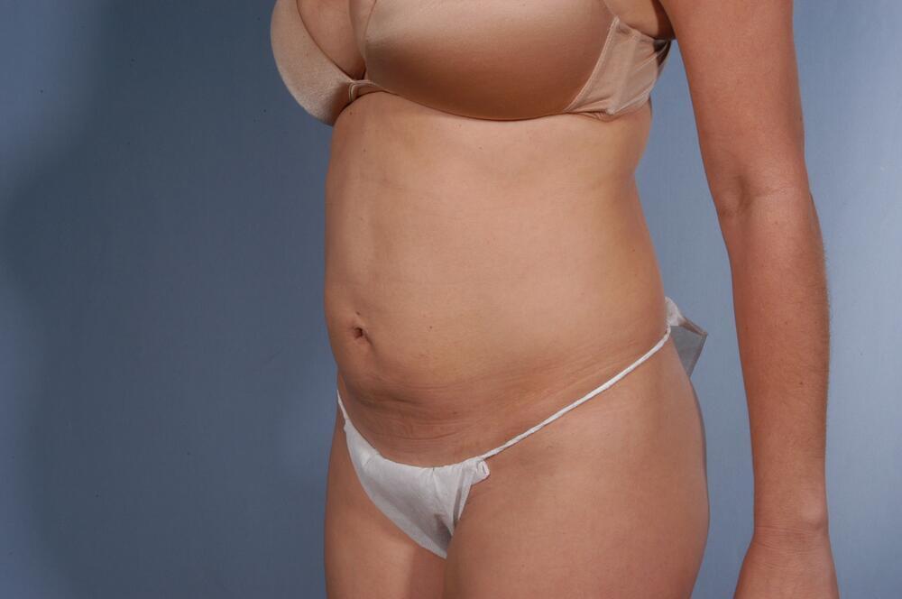 Tummy tuck Before & After Image