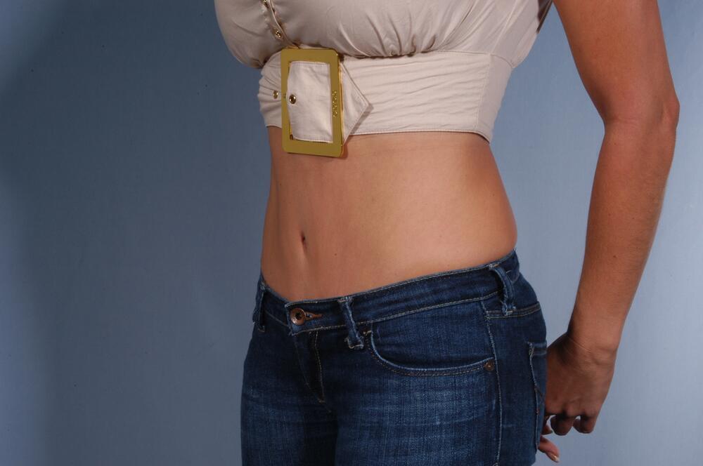 Tummy tuck Before & After Image