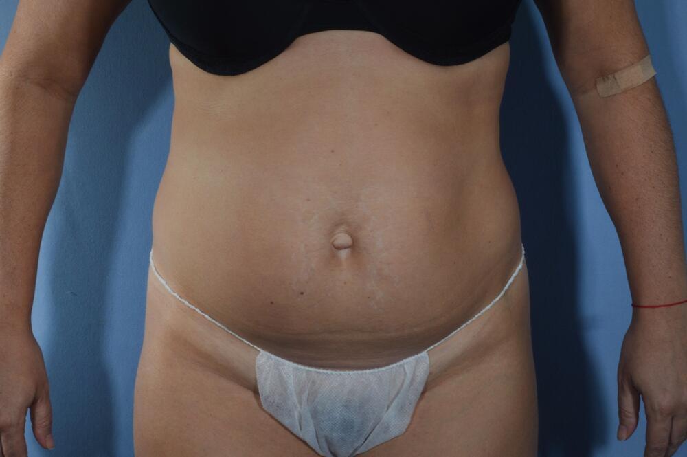 Tummy tuck Before & After Image