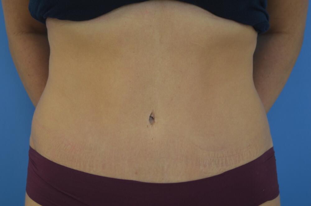 Tummy tuck Before & After Image