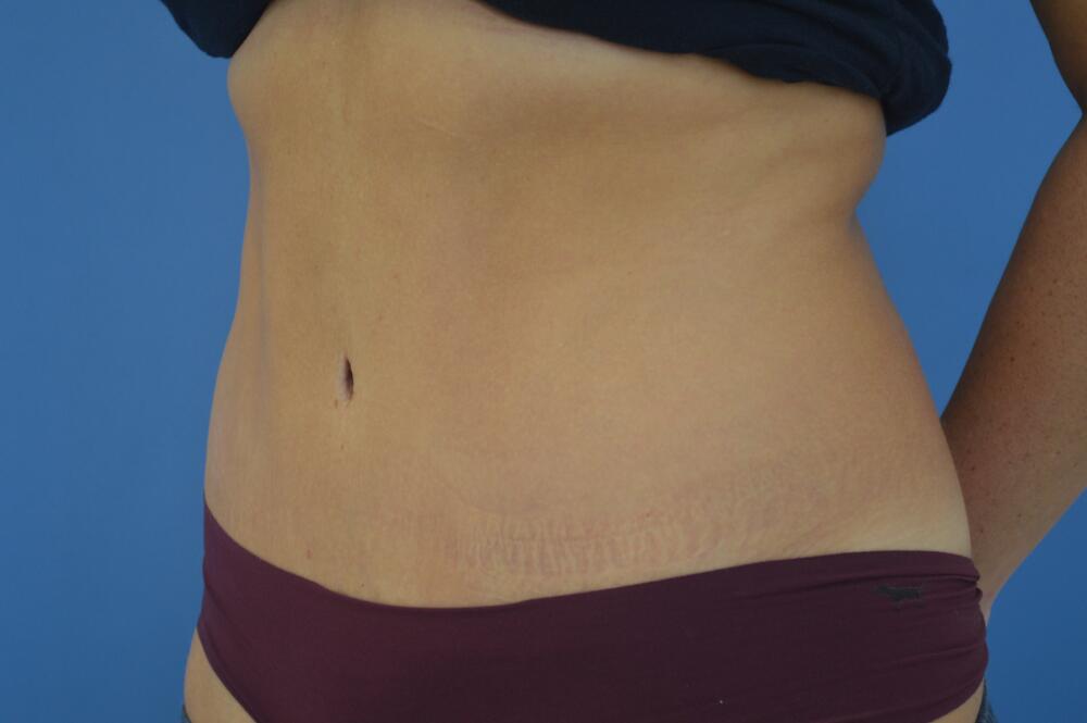 Tummy tuck Before & After Image