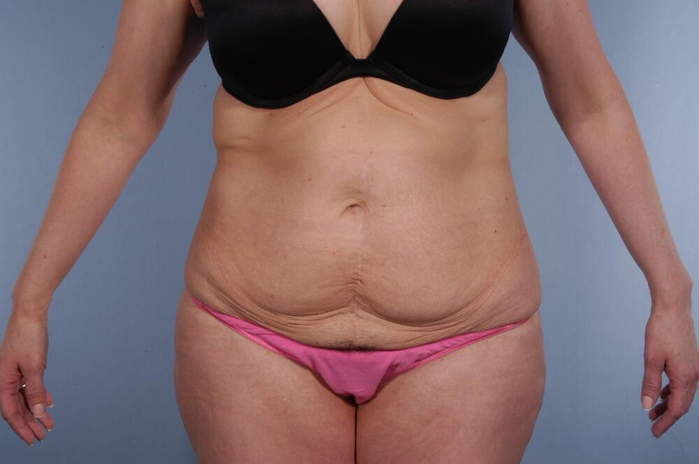 Tummy tuck Before & After Image