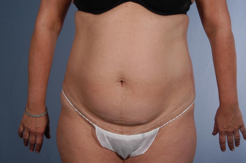 Tummy tuck Before & After Image
