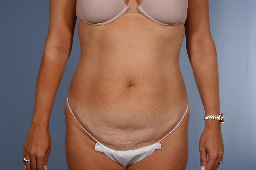 Tummy tuck Before & After Image
