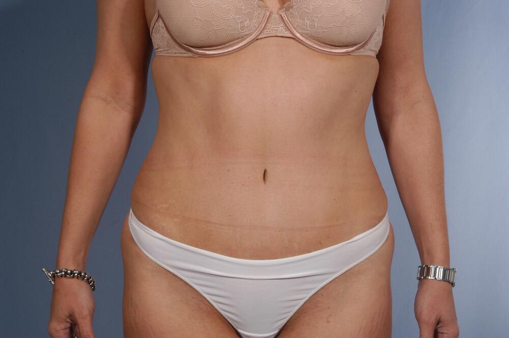 Tummy tuck Before & After Image