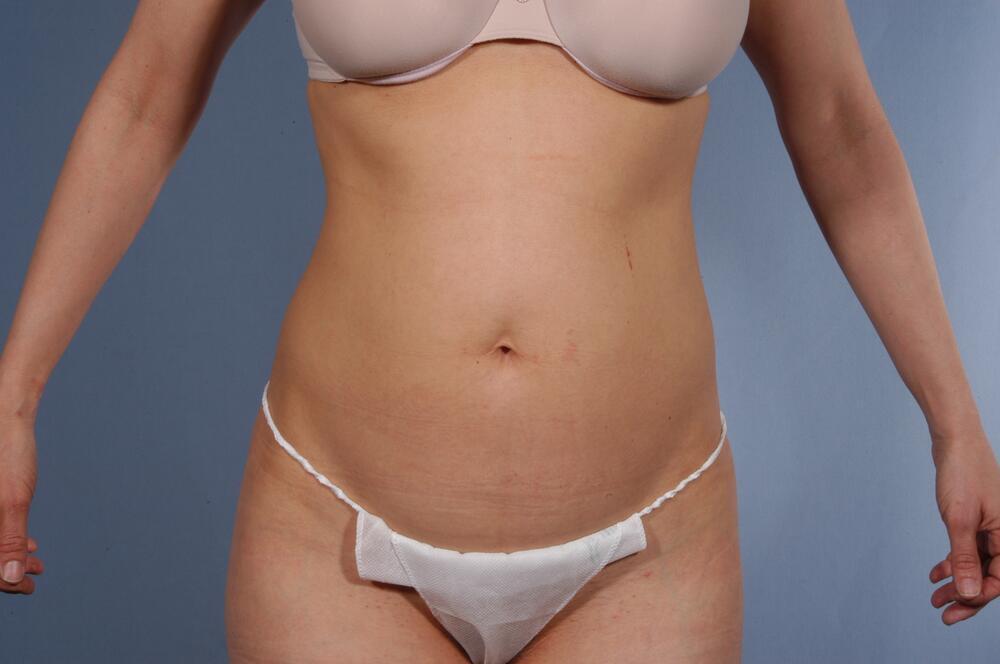 Tummy tuck Before & After Image