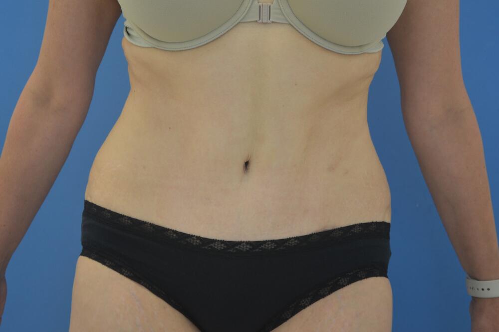 Tummy tuck Before & After Image