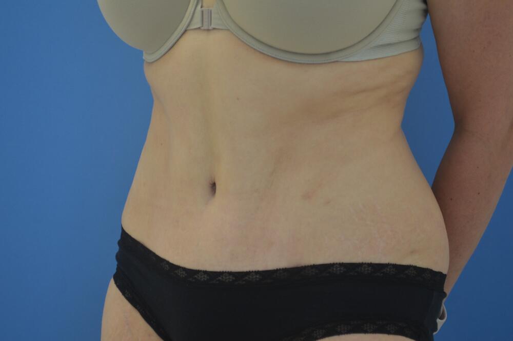 Tummy tuck Before & After Image
