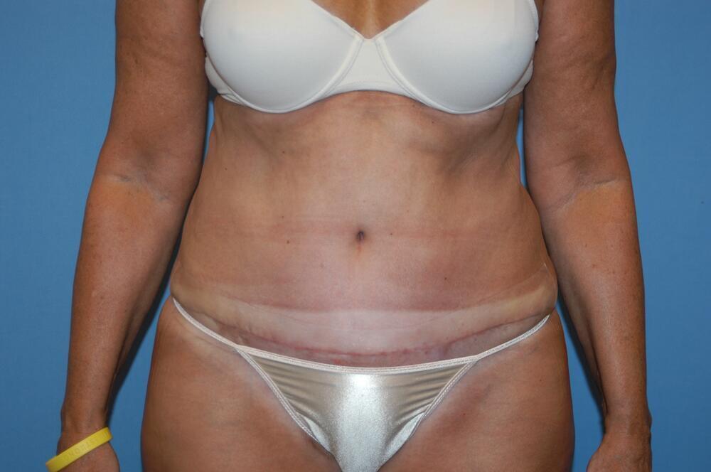 Tummy tuck Before & After Image