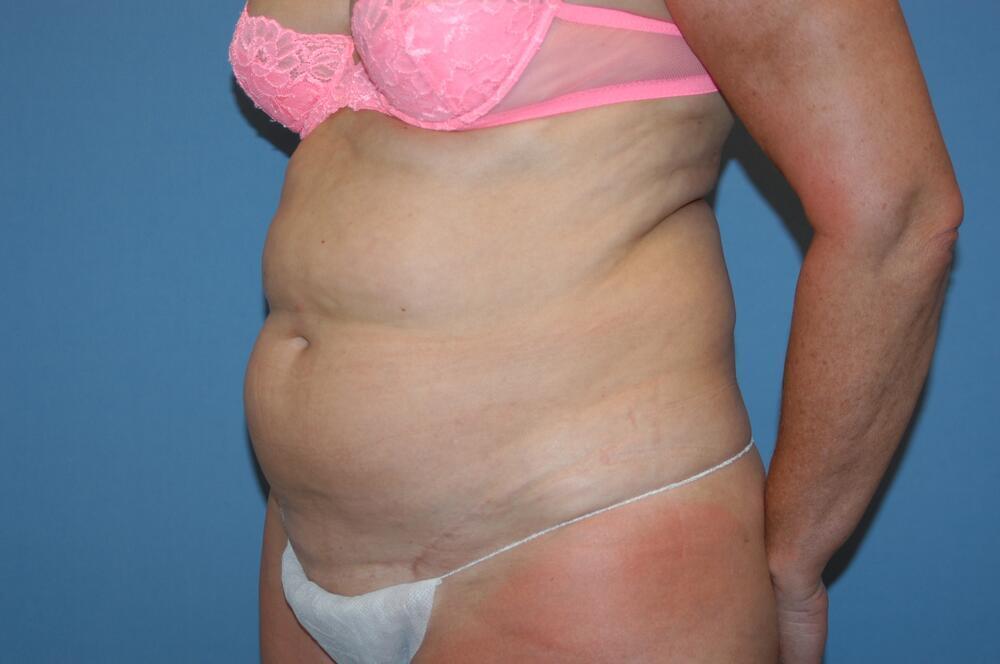 Tummy tuck Before & After Image