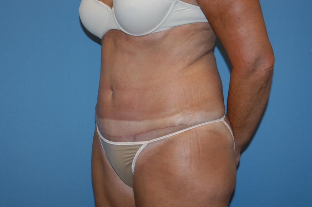 Tummy tuck Before & After Image