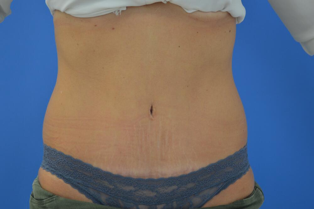 Tummy tuck Before & After Image