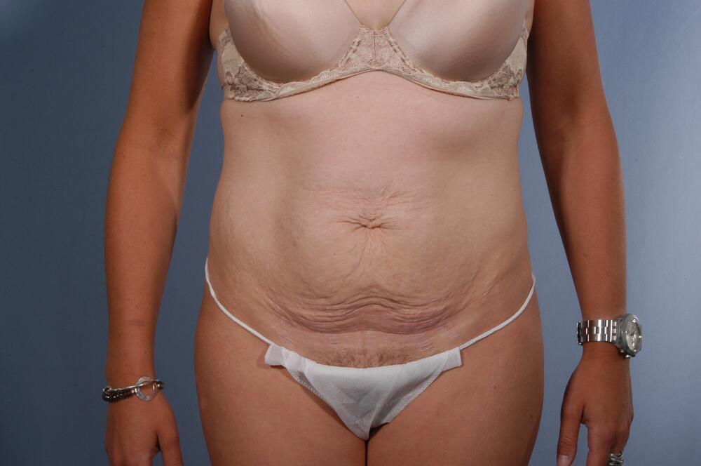 Tummy tuck Before & After Image