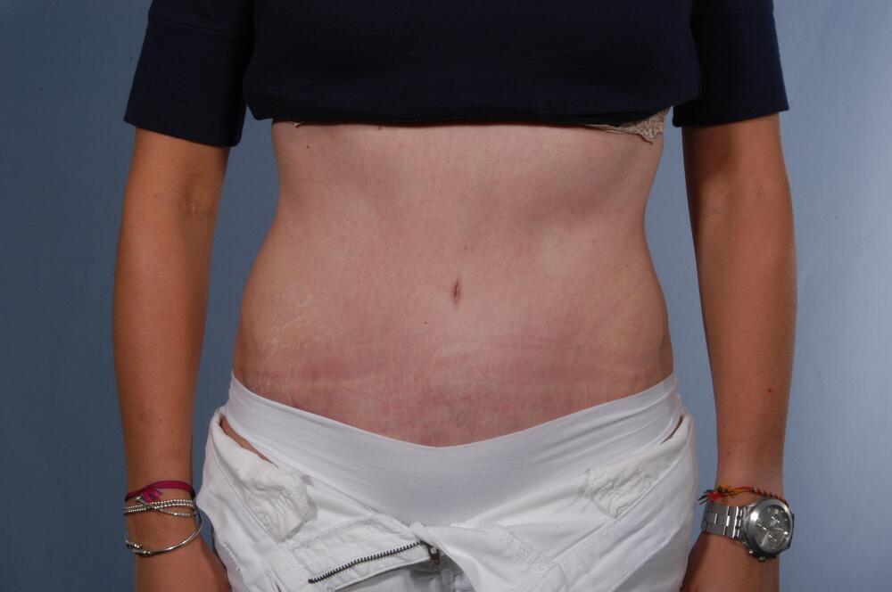 Tummy tuck Before & After Image