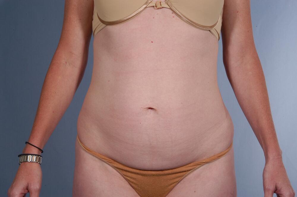 Tummy tuck Before & After Image