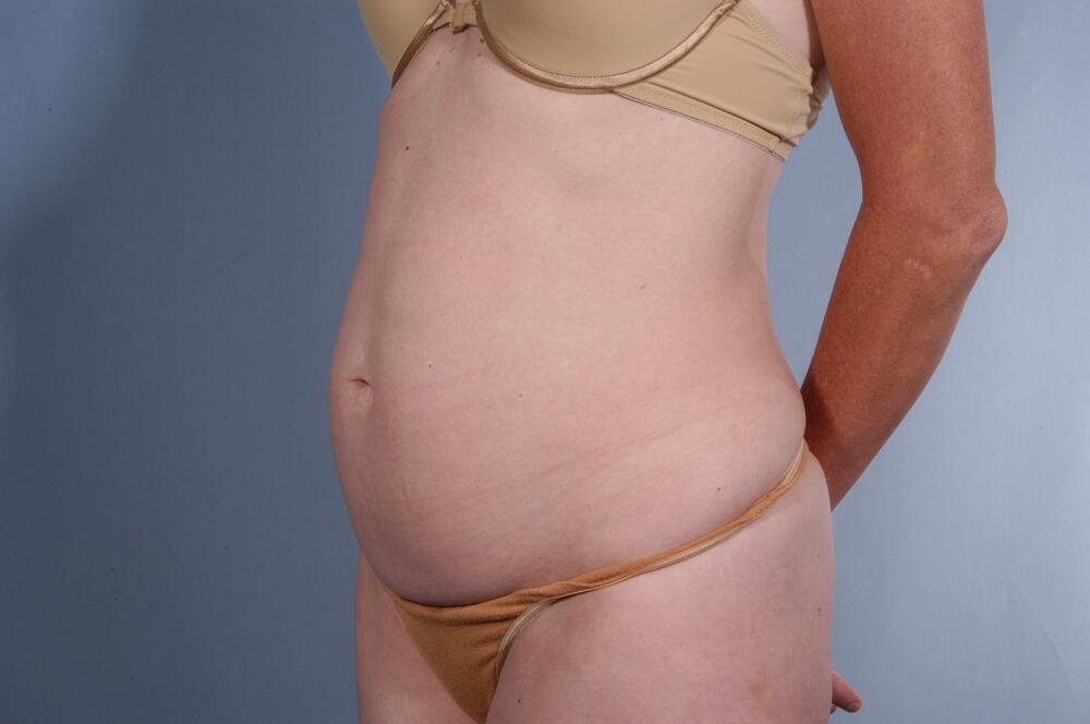 Tummy tuck Before & After Image