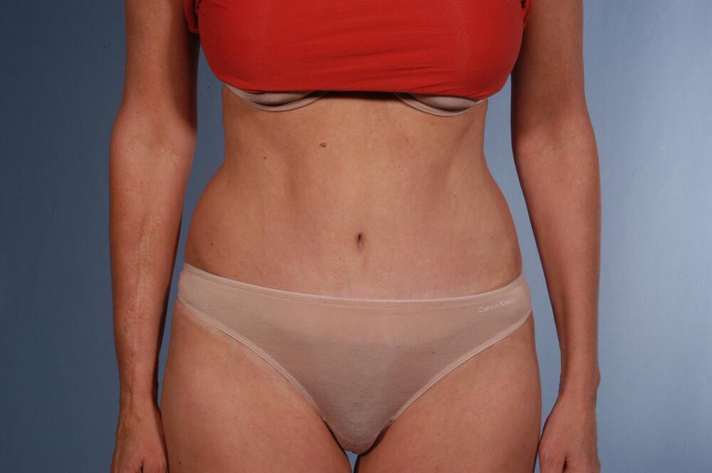 Tummy tuck Before & After Image