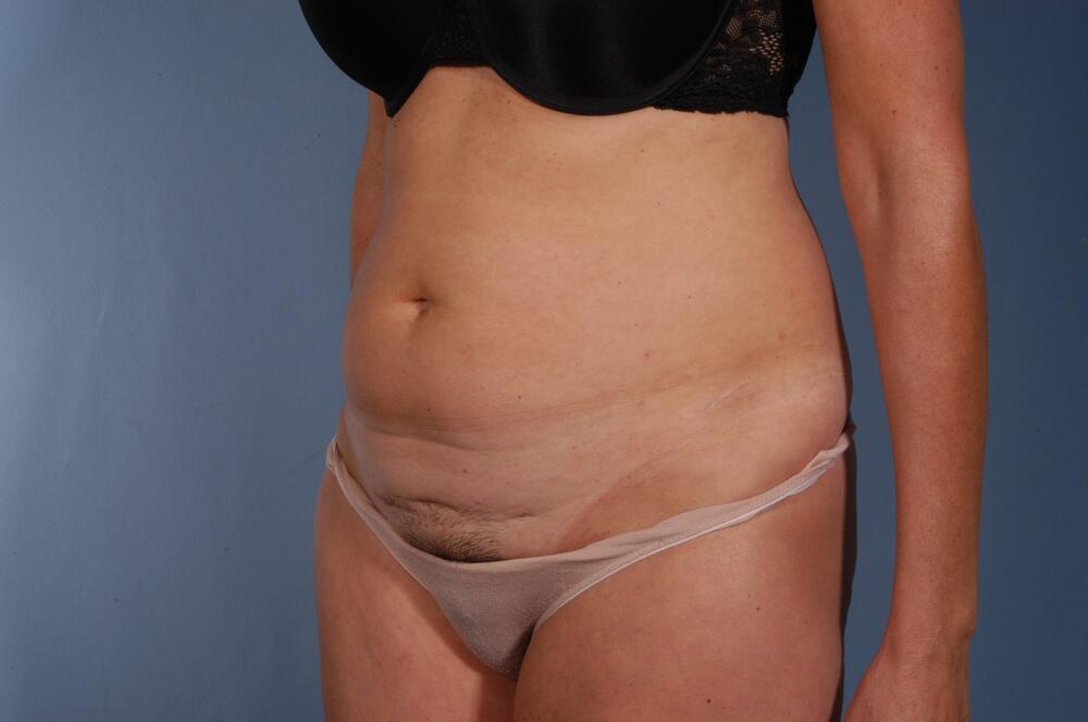 Tummy tuck Before & After Image