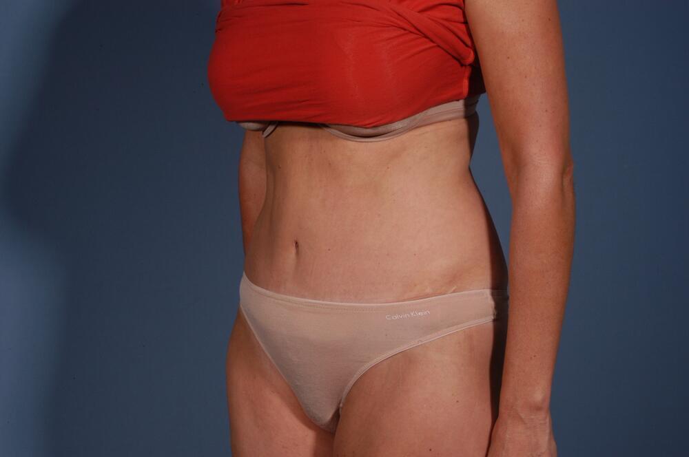 Tummy tuck Before & After Image
